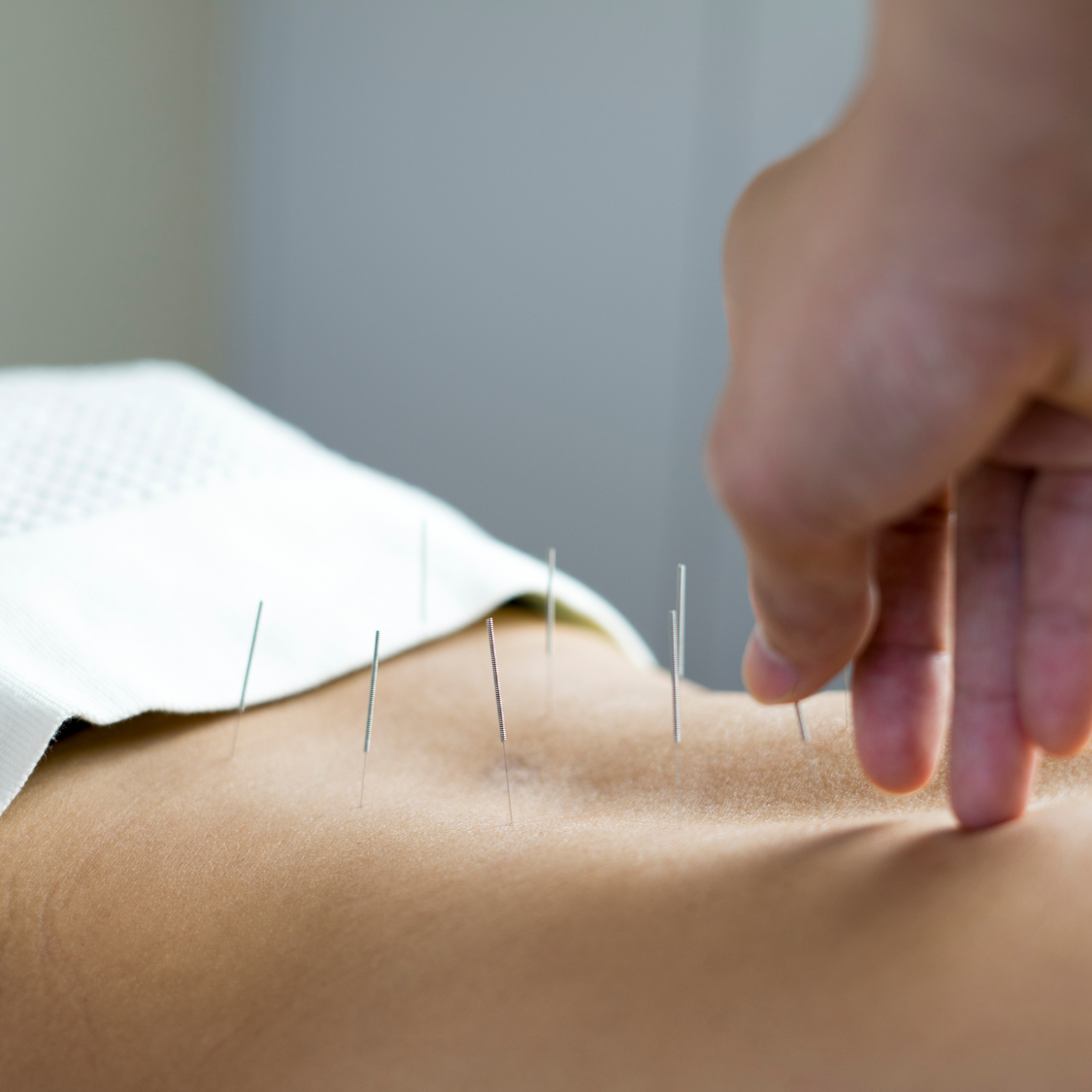 A physiotherapist performing dry needling therapy at BetterSelf Physiotherapy to relieve muscle pain and tension
